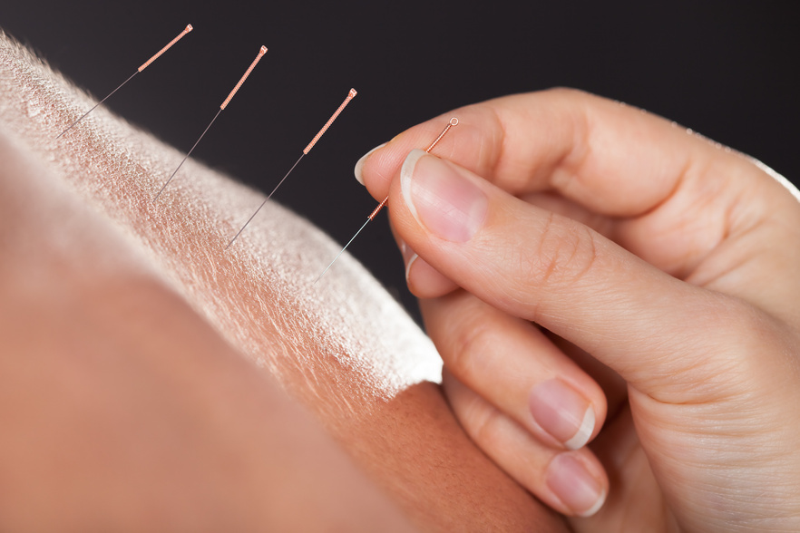 Man Getting Acupuncture Treatment